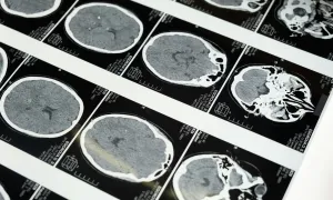 brain MRI